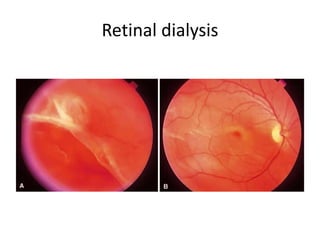 DR WANI'S TALK ON RETINAL DETACHMENT LECTURE FOR RESIDENTS [DR WANI ...