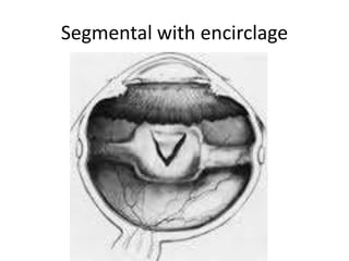 Fragmental Eye DR WANI'S TALK ON RETINAL DETACHMENT LECTURE FOR RESIDENTS [DR WANI ...