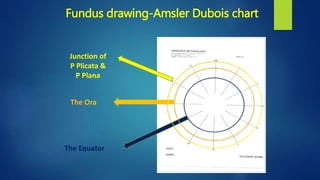 Fundus drawing-Amsler Dubois chart
Junction of
P Plicata &
P Plana
The Ora
The Equator
 