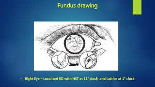 Fundus drawing
• Right Eye – Localized RD with HST at 11° clock and Lattice at 1° clock
 