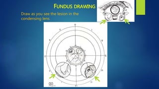 FUNDUS DRAWING
Draw as you see the lesion in the
condensing lens
 