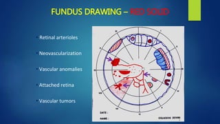 FUNDUS DRAWING – RED SOLID
• Retinal arterioles
• Neovascularization
• Vascular anomalies
• Attached retina
• Vascular tumors
 