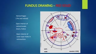 FUNDUS DRAWING – RED SOLID
• Hemorrhages
( Pre and retinal)
• Open interior of
retinal breaks
(tears, holes)
• Open interior of
outer layer holes in
retinoschisis
 