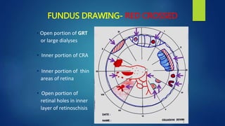 • Open portion of GRT
or large dialyses
• Inner portion of CRA
• Inner portion of thin
areas of retina
• Open portion of
retinal holes in inner
layer of retinoschisis
FUNDUS DRAWING- RED CROSSED
 