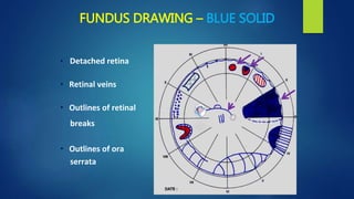 FUNDUS DRAWING – BLUE SOLID
• Detached retina
• Retinal veins
• Outlines of retinal
breaks
• Outlines of ora
serrata
 