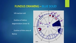 FUNDUS DRAWING – BLUE SOLID
• VR traction tuft
• Outline of lattice
degeneration (inner X)
• Outline of thin area of
Retina
 