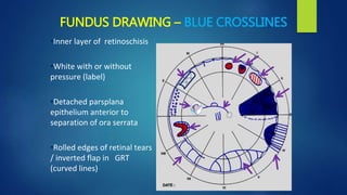 FUNDUS DRAWING – BLUE CROSSLINES
•Inner layer of retinoschisis
•White with or without
pressure (label)
•Detached parsplana
epithelium anterior to
separation of ora serrata
•Rolled edges of retinal tears
/ inverted flap in GRT
(curved lines)
 