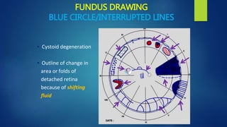 FUNDUS DRAWING
BLUE CIRCLE/INTERRUPTED LINES
• Cystoid degeneration
• Outline of change in
area or folds of
detached retina
because of shifting
fluid
 