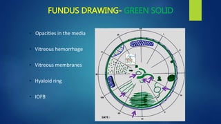 FUNDUS DRAWING- GREEN SOLID
• Opacities in the media
• Vitreous hemorrhage
• Vitreous membranes
• Hyaloid ring
• IOFB
 