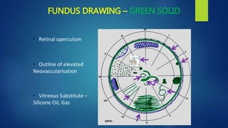 FUNDUS DRAWING – GREEN SOLID
• Retinal operculum
• Outline of elevated
Neovascularisation
• Vitreous Substitute –
Silicone Oil, Gas
 