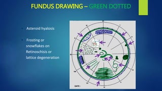 FUNDUS DRAWING – GREEN DOTTED
• Asteroid hyalosis
• Frosting or
snowflakes on
Retinoschisis or
lattice degeneration
 