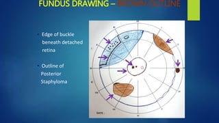 FUNDUS DRAWING – BROWN OUTLINE
• Edge of buckle
beneath detached
retina
• Outline of
Posterior
Staphyloma
 