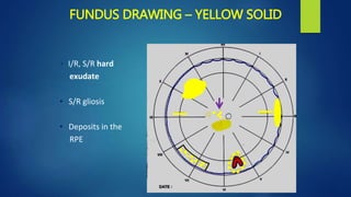 FUNDUS DRAWING – YELLOW SOLID
• I/R, S/R hard
exudate
• S/R gliosis
• Deposits in the
RPE
 