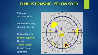 FUNDUS DRAWING- YELLOW SOLID
• Post cryo
retinal edema
• Substance of long
& short ciliary N
• Retinoblastoma
Yellow – stippled-
• Drusen
Yellow Crossed
• Chorioretinal
coloboma
 