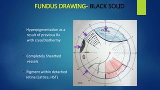 FUNDUS DRAWING- BLACK SOLID
• Hyperpigmentation as a
result of previous Rx
with cryo/Diathermy
• Completely Sheathed
vessels
• Pigment within detached
retina (Lattice, HST)
 