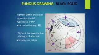 FUNDUS DRAWING- BLACK SOLID
• Pigment within choroid or
pigment epithelial
hyperplasia within
attached retina (e.g. RP)
• Pigment demarcation line
at margin of attached
and detached retina
 