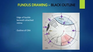 FUNDUS DRAWING – BLACK OUTLINE
• Edge of buckle
beneath attached
retina
• Outline of CRA
 