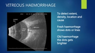 VITREOUS HAEMORRHAGE
To detect extent,
density, location and
cause
Fresh haemorrhage
shows dots or lines
Old haemorrhage
the dots gets
brighter
 