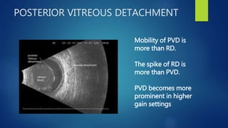 POSTERIOR VITREOUS DETACHMENT
Mobility of PVD is
more than RD.
The spike of RD is
more than PVD.
PVD becomes more
prominent in higher
gain settings
 