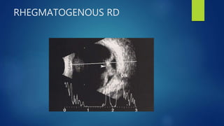 RHEGMATOGENOUS RD
 