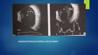 RHEGMATOGENOUS RETINAL DETACHMENT
 