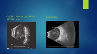 CLOSED FUNNEL RD WITH
RETINAL CYST
Retinal Tear
 