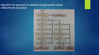 Algorithm for approach to selection of appropriate retinal
reattachment procedure
 
