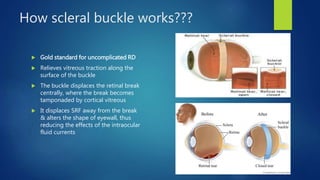 How scleral buckle works???
 Gold standard for uncomplicated RD
 Relieves vitreous traction along the
surface of the buckle
 The buckle displaces the retinal break
centrally, where the break becomes
tamponaded by cortical vitreous
 It displaces SRF away from the break
& alters the shape of eyewall, thus
reducing the effects of the intraocular
fluid currents
 