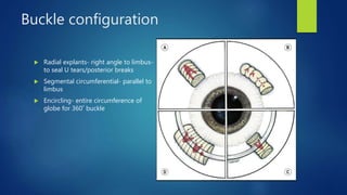 Buckle configuration
 Radial explants- right angle to limbus-
to seal U tears/posterior breaks
 Segmental circumferential- parallel to
limbus
 Encircling- entire circumference of
globe for 360˚ buckle
 