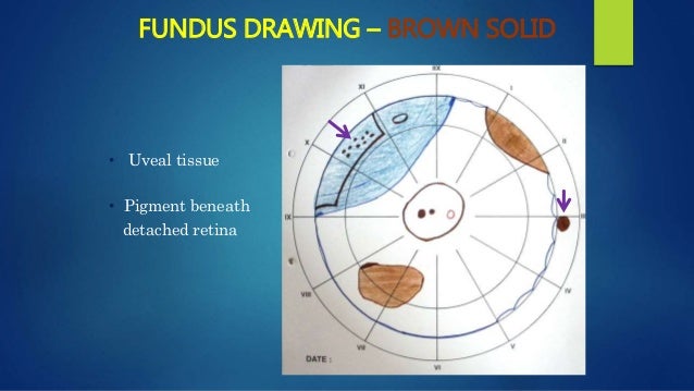 Management Of Retinal Detachment - 