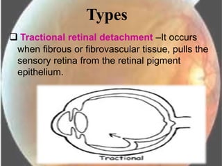 Mild Tractional Rd Retinal detachment new | PPTX