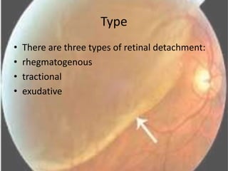 Types of Retinal Detachment, Their Causes, and Treatments