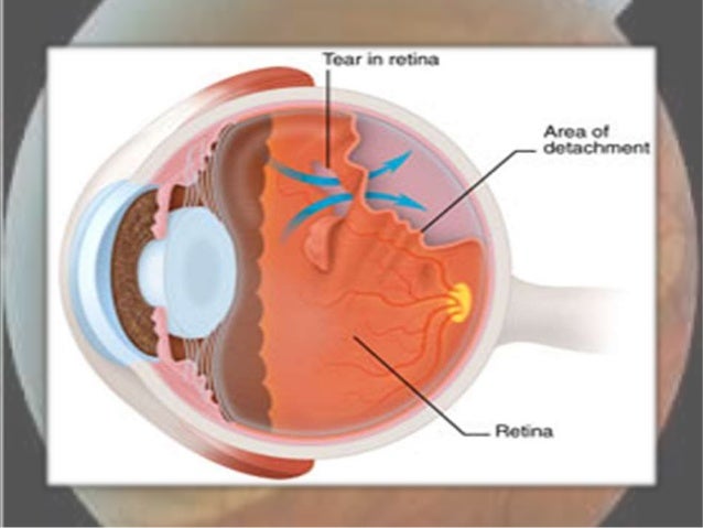 tractional retinal detachment