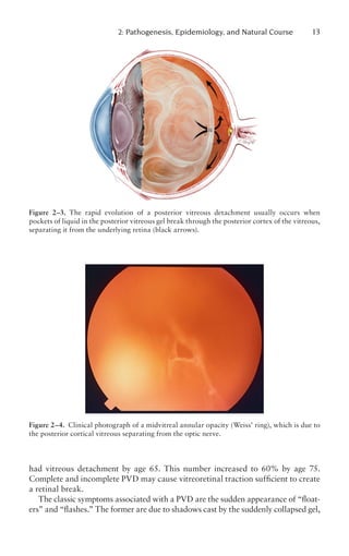 Pvd Retina Incomplete Retinal Detachment Principles and Practice 3rd Ed.pdf