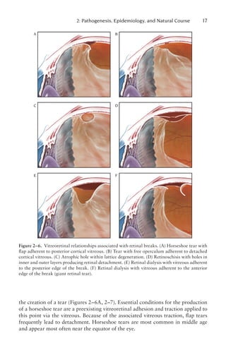 Retinal Detachment Principles and Practice 3rd Ed.pdf