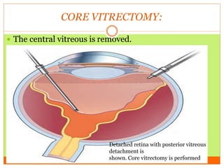 Core Vitrectomy RETINAL DETACHMENT SURGERY 2.pptx