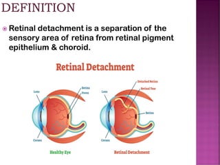 Retinal detachment is a separation of the
sensory area of retina from retinal pigment
epithelium & choroid.
 