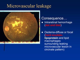 Microvascular leakage
Consequence…
 Intraretinal hemorrhage
(dot and blot)
 Oedema-diffuse or focal
(hard exudate-
lipoprotein and lipid
macrophages
surrounding leaking
microvascular lesion in
circinate pattern)
 