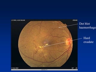 Dot blot
haemorrhage
Hard
exudate
 