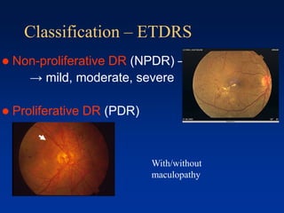 Classification – ETDRS
 Non-proliferative DR (NPDR) –
→ mild, moderate, severe
 Proliferative DR (PDR)
With/without
maculopathy
 