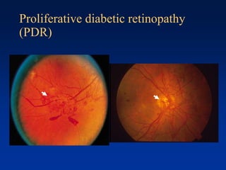 Proliferative diabetic retinopathy
(PDR)
 