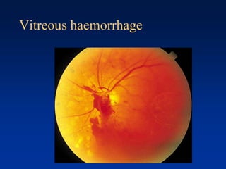 Vitreous haemorrhage
 