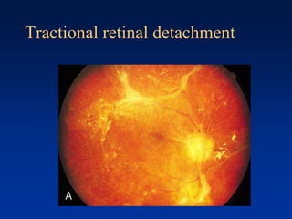 Tractional retinal detachment
 