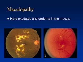 Maculopathy
 Hard exudates and oedema in the macula
 