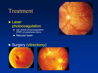 Treatment
 Laser
photocoagulation
 pan-retinal photocoagulation
(PRP) of peripheral retina
 Macular laser
 Surgery (vitrectomy)
 