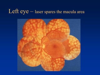 Left eye – laser spares the macula area
 