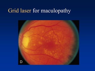 Grid laser for maculopathy
 