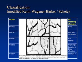 Classification
(modified Keith-Wagener-Barker / Scheie)
Grade Haemorr-
hage
Exudate Disc
swelling
AV ratio Light
reflex
AV
crossing
changes
Normal none none none 3:4 Fine
yellow
None
Grade 1 none none none 1:2 Broad
yellow
Mild vein
depression
Grade 2 none none none 1:3 Copper
wiring
A-V
nipping
Grade 3
+ + none 1:4 Silver
wiring
Right angle
Deviation /
Distal
dilatation
Grade 4
+ + + fine
cords
as stage 3 as stage 3
 