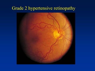 Grade 2 hypertensive retinopathy
 