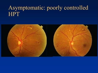 Asymptomatic: poorly controlled
HPT
 